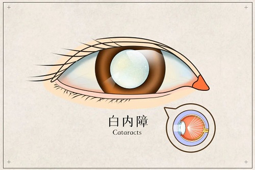 【健康科普】視線模糊不清？當心患上白內障